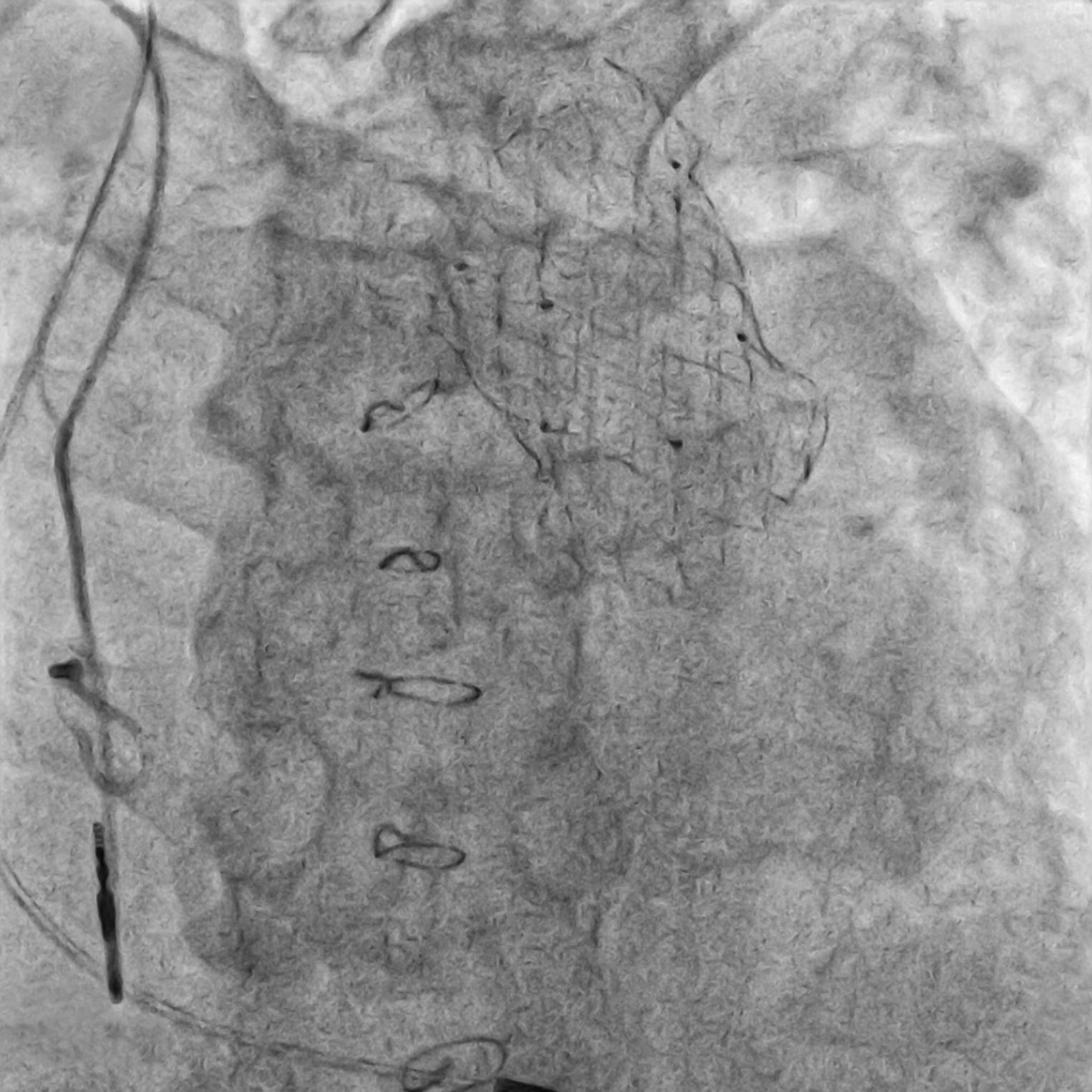 X-ray image with a fine, net-like mesh.